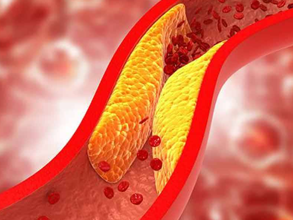 Young People are at Risks of High Cholesterol